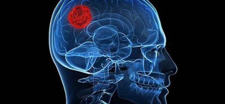 Daño cerebral, una pandemia